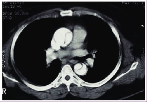 CT Aortogram Showing Type A Aortic Dissection. | Download Scientific ...