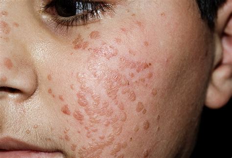 Warts on Face: All Possible Locations, Their Causes, and Effective ...