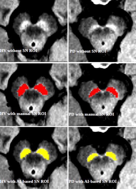 Investigating Substantia Nigra Damage using Fully Automated ...