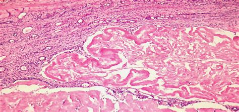 9.Corpus albicans ovarii. | Pathology