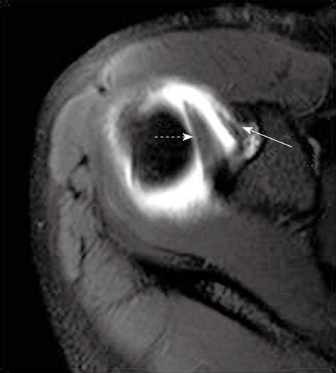 Glenohumeral Ligament Mri