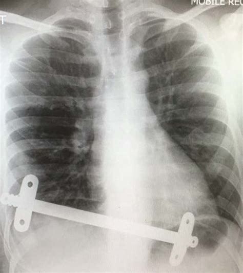 Chest X-ray taken after the removal of the upper substernal bar. The ...