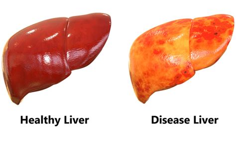 5 such things that cure liver disease, must read once