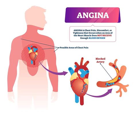 Angina Pectoris (Stable Angina); Causes, Symptoms, and Treatment