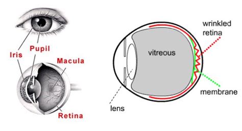 Epiretinal Membrane Surgery – Durban Retinal Associates