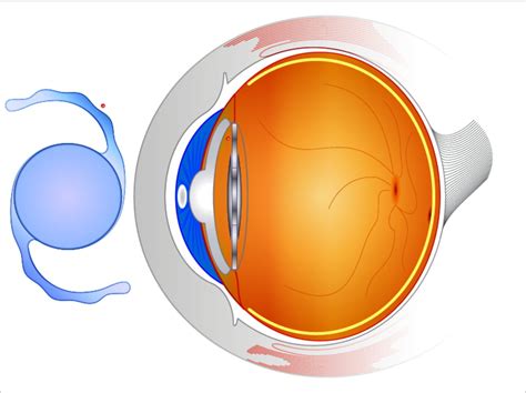 ICL Implantation - Sanjivani Eye Hospital