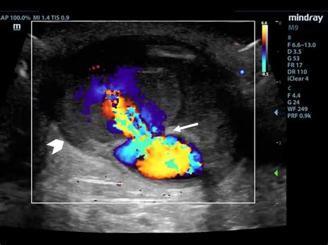 Point of Care Ultrasound Diagnosis of Pseudoaneurysm of an Upper ...