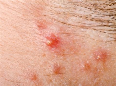 What are the signs and symptoms of folliculitis?