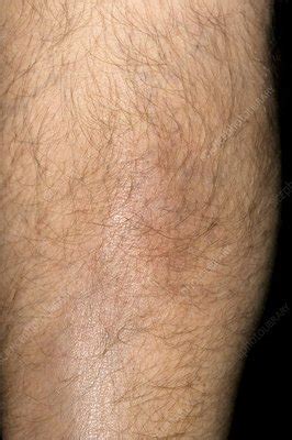 Superficial phlebitis after leg injury - Stock Image M330/1757 - Science Photo Library