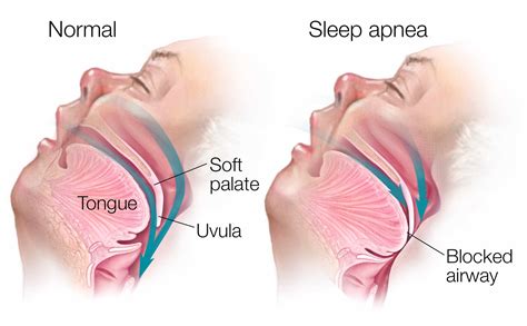 Sleep Apnea & Snoring Guards | Premier Dental Center - Ferndale, WA