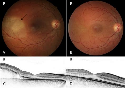 Fundus changes in DIC. A: Funduscopic image of patient 1 with DIC at... | Download Scientific ...