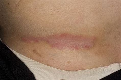 Inverse psoriasis images | Symptoms and pictures