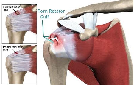 Rotator Cuff Tear Of Left Shoulder Anterior And Lateral Views Medium X 30\) Printed Trial Exhibi ...