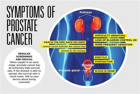 How To Know If Prostate Cancer Has Spread To The Bones / Prostate Cancer Symptoms Diagnosis ...