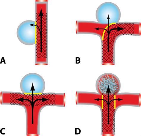 Flow diversion to treat aneurysms: the free segment of stent | Journal ...