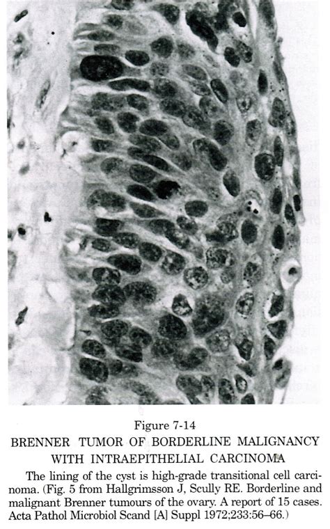 Pathology Outlines - Borderline Brenner tumor