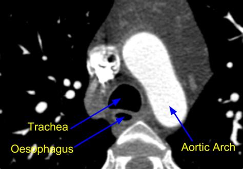 Cardiac CT scan – Aortic arch level – All About Cardiovascular System ...