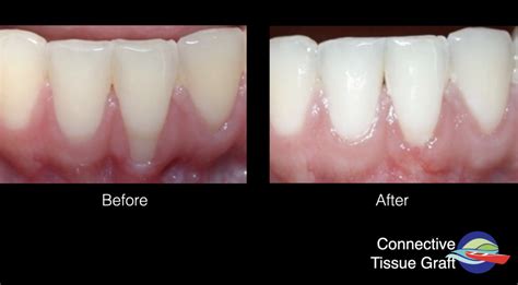 What is gum recession? Causes, Symptoms, and Treatment - Dr. Peter Fritz