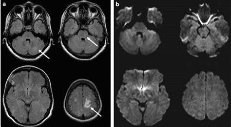 Hypertensive Encephalopathy definition,diagnosis,DD and treatment