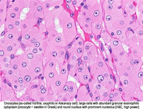 Hurthle cells - wikidoc