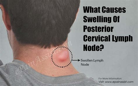 Headache swollen lymph nodes neck pain information | aboutheadache