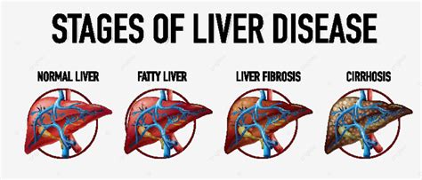 Stages Of Liver Disease Physiological Sciences Health Vector ...