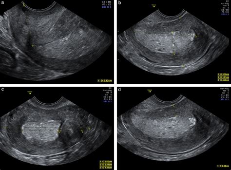 Ultrasound characteristics of endometrial cancer as defined by International Endometrial Tumor ...