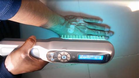 Uv Light Treatment For Psoriasis Reviews | Shelly Lighting