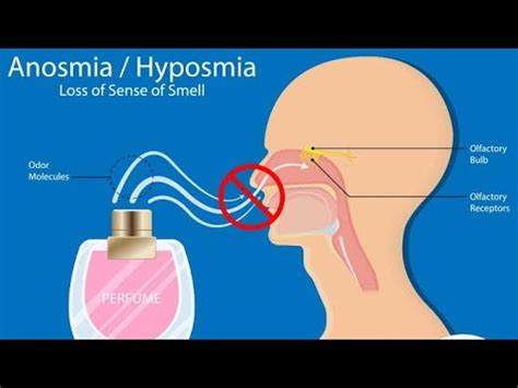 Anosmia; Hyposmia the temporary or permanent loose of sense of smell; dysfunction of olfactory ...