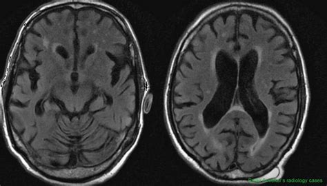 Dr Balaji Anvekar FRCR: Superficial Siderosis MRI