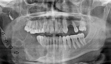 Ameloblastoma - MEDizzy