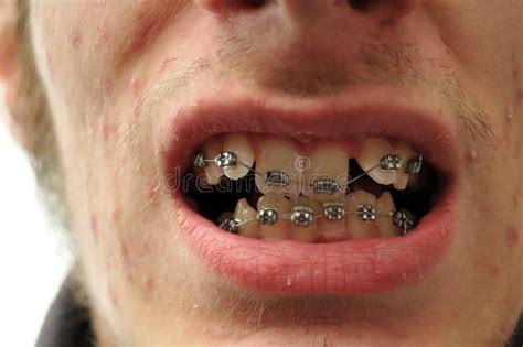 Close Up Of Crooked Teeth With Braces Stock Photo - Image of teeth ...