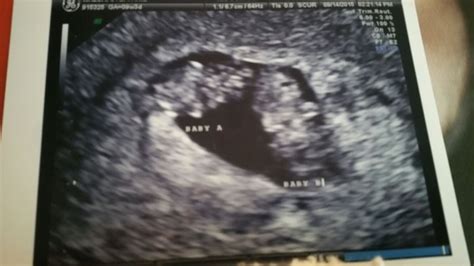 9 week ultrasound pic and heartbeat please! - BabyCenter