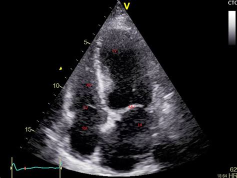 Echocardiography Imaging Techniques Article