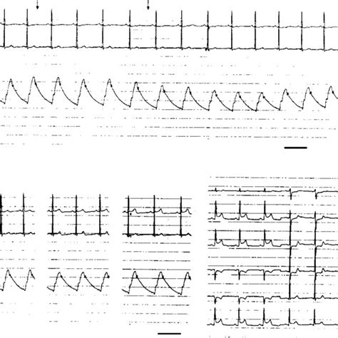 ECG at baseline and after carotid sinus massage. Ischaemic ECG change... | Download Scientific ...