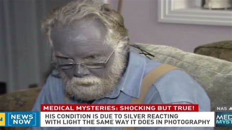 What killed the man with blue skin? | CNN