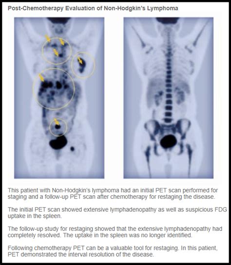 Lymphoma Stage 4 Cancer Pet Scan : Current Status Of Pet Ct In The Diagnosis And Follow Up Of ...