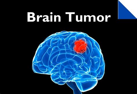 Brain Tumor Symptoms You Can Recognize Even Before You Go To A Doctor