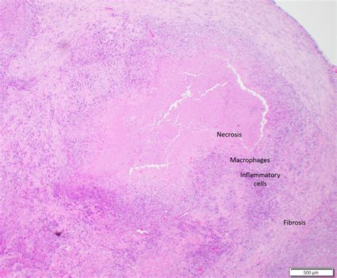 Caseating Granuloma Histology