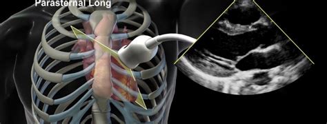 Medmovie.com | ASE Transthoracic Echocardiography: Left Parasternal Long Position (edited)