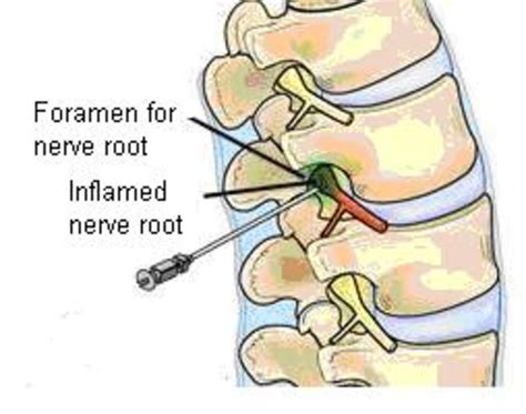 Epidural Nerve Root Block Injection - A Personal Experience