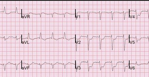 Dr. Smith's ECG Blog: Beware confusing the diagnosis of posterior STEMI by using posterior leads...