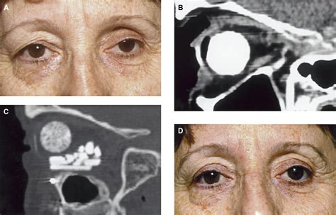 Figure 1 from Diagnosis and management of enophthalmos. | Semantic Scholar