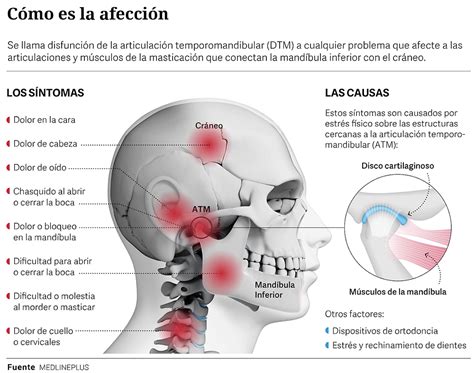 Disfunción de la Articulación Temporomandibular (ATM)