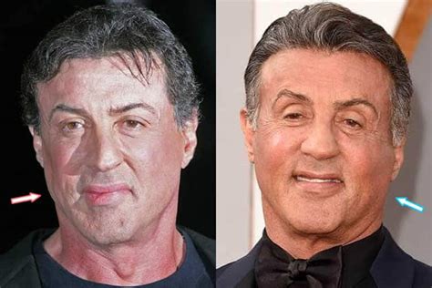 Sylvester Stallone Plastic Surgery - Hair, Facelift, Botox, Nose Job?