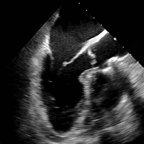 Cardiac Ultrasound Training - Heart Ultrasound, Cardiology Ultrasound