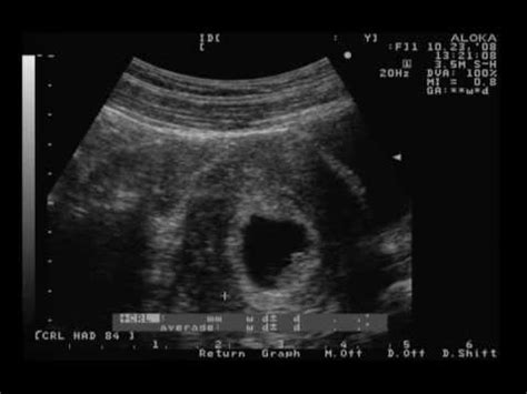 Ultrasound 7 weeks 3 days - TWINS! - YouTube