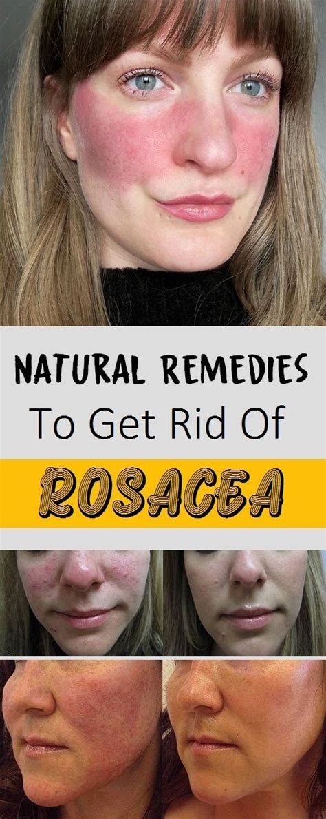 5 Natural Remedies To Get Rid Of Rosacea (With images) | Rosacea, Natural remedies for rosacea ...