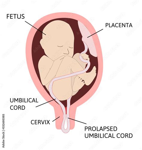 Prolapsed umbilical cord. umbilical cord comes out of the uterus with or before the presenting ...