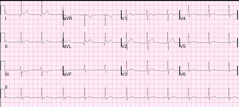 Dr. Smith's ECG Blog: Pseudo High Lateral STEMI -- How not to be ...